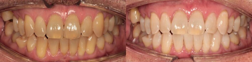 Teeth Whitening // Teeth Whitening