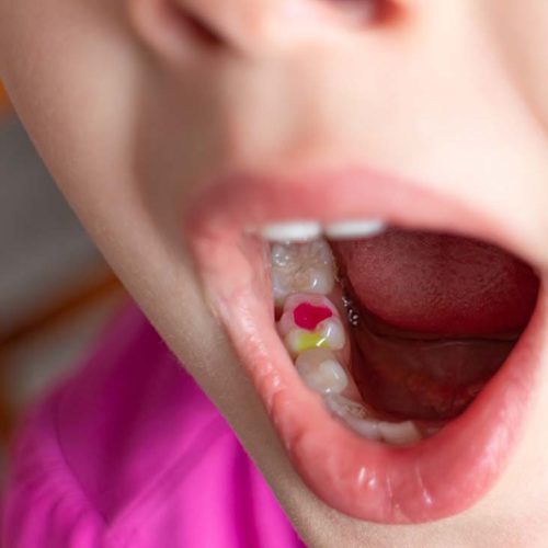 A girl showing her colorful filling in milk teeth.