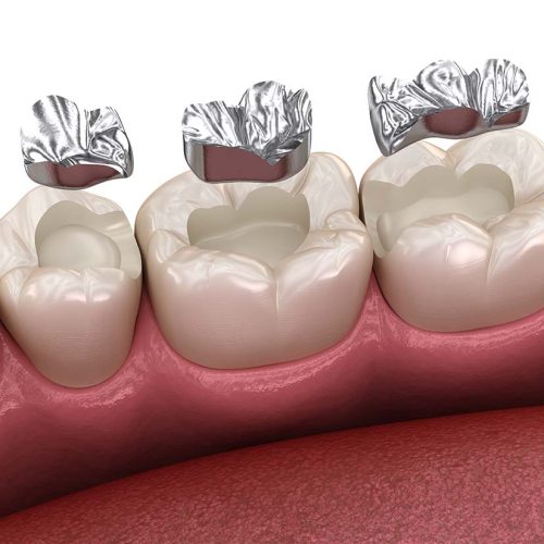 Amalgam restoration. Medically accurate 3D animation of dental concept